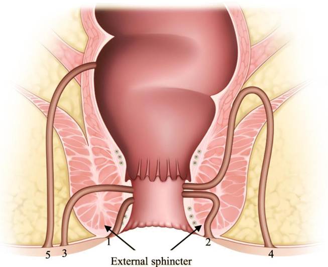 fistulas