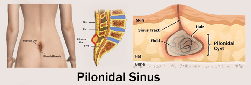 proctologista trata cisto pilonidal