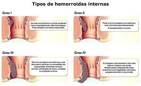 hemorroidas internas
