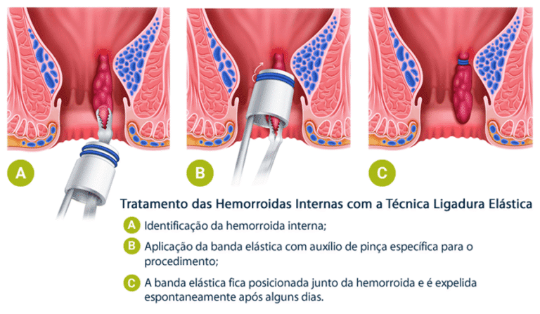 Entenda sobre hemorroidas - Dra Renata Ramalho proctologista em Brasília