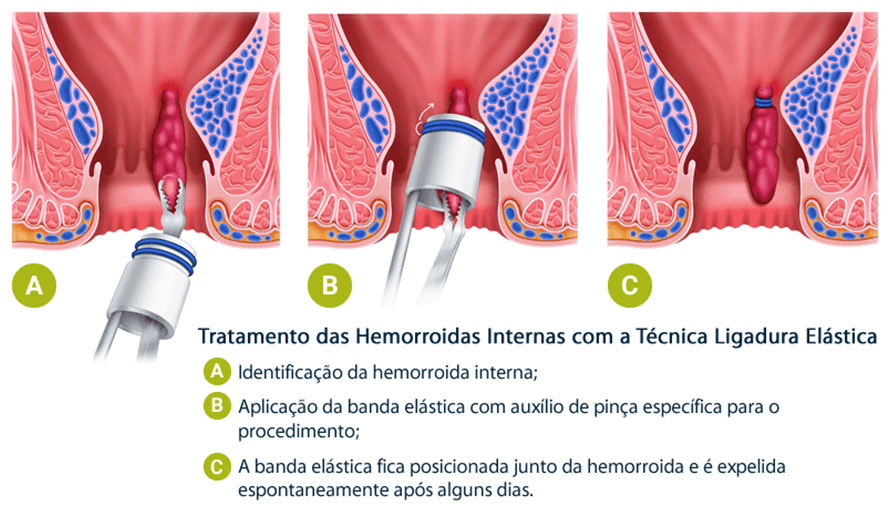 ligadura elastica de hemorroidas