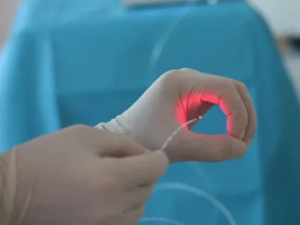 laser para tratamento de hemorroidas