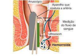 desarterialização de hemorroidas