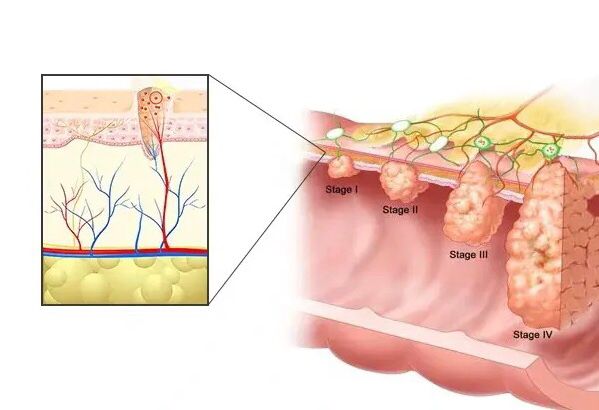 HPV anal