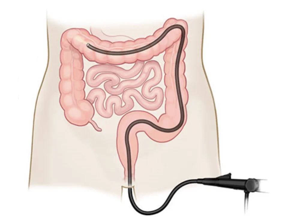 colonoscopia