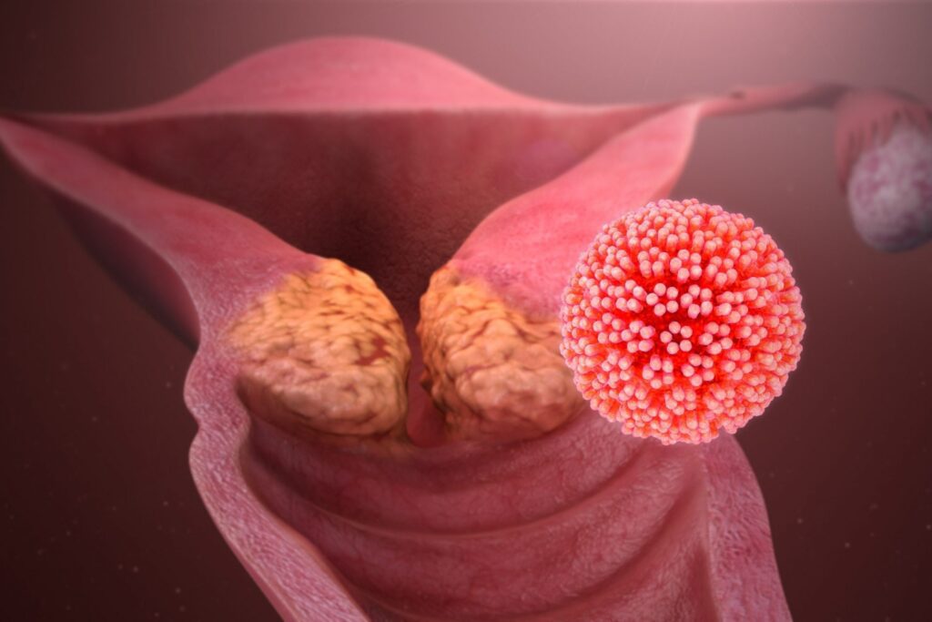 HPV anal