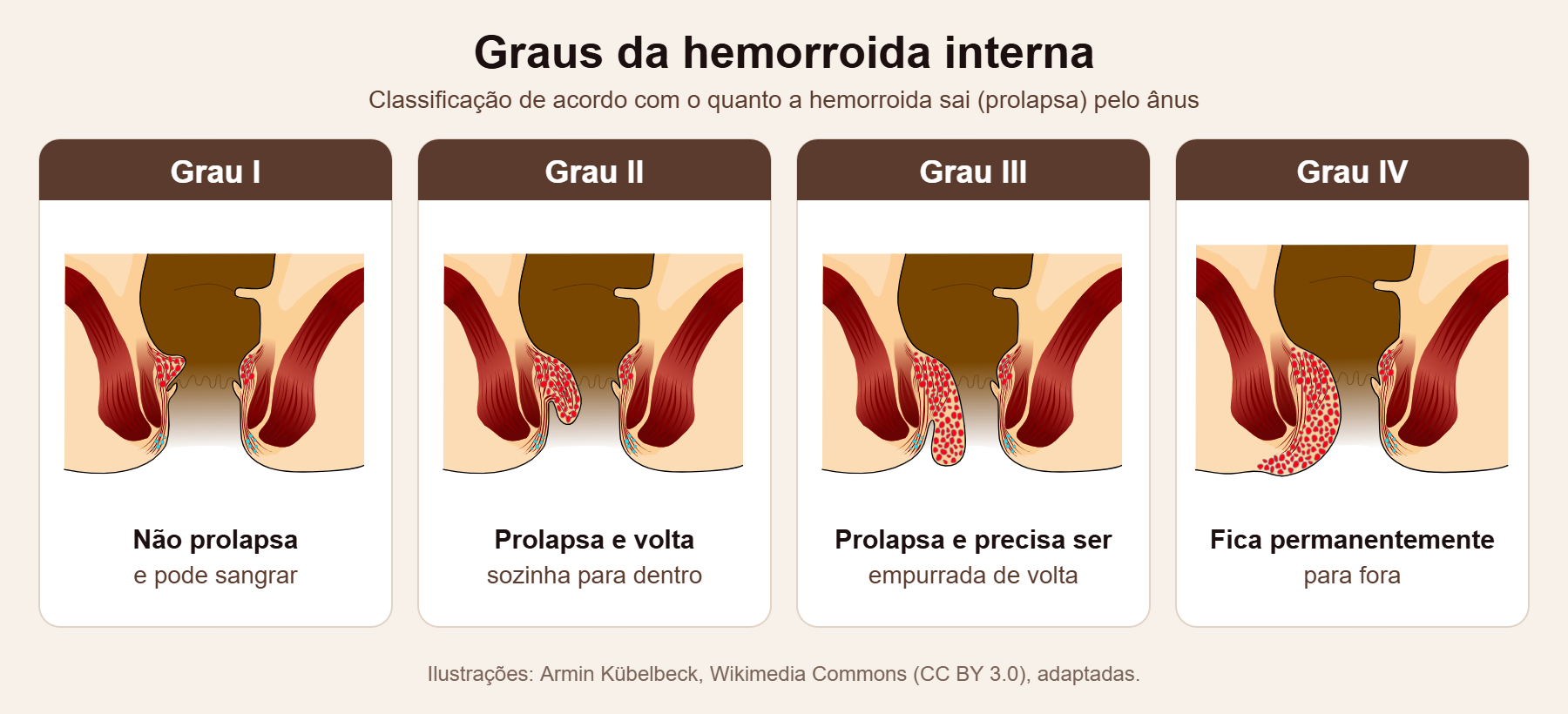 Ilustração dos graus da hemorroida interna: grau I não prolapsa, grau II prolapsa e volta sozinha, grau III precisa ser empurrada de volta e grau IV fica permanentemente para fora