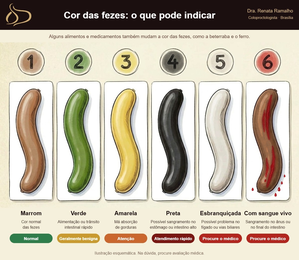 Ilustração das cores das fezes e o que podem indicar: marrom é normal; verde geralmente é benigna; amarela indica má absorção de gorduras; preta, possível sangramento alto; esbranquiçada, problema no fígado ou vias biliares; com sangue vivo, sangramento no ânus ou final do intestino
